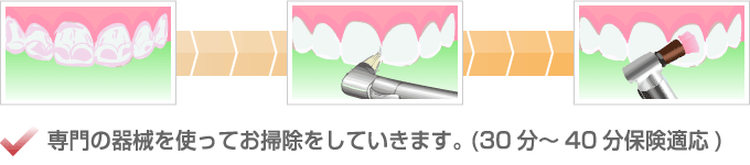 専門の器械を使ってお掃除をしていきます。（３０分～４０分保険適応）